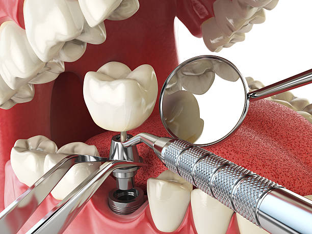 Best Emergency Tooth Extraction in Wahneta, FL